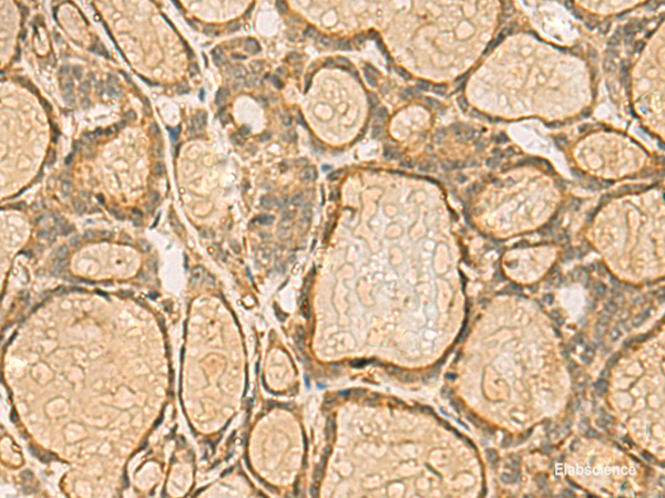 Immunohistochemistry of paraffin-embedded Human thyroid cancer tissue using HORMAD2 Polyclonal Antibody at dilution of 1:45(×200)