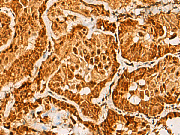 Immunohistochemistry of paraffin-embedded Human thyroid cancer tissue using SAP30BP Polyclonal Antibody at dilution of 1:40(×200)