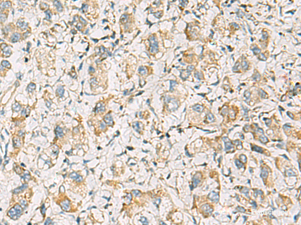 Immunohistochemistry of paraffin-embedded Human liver cancer tissue using PDE4DIP Polyclonal Antibody at dilution of 1:60(×200)