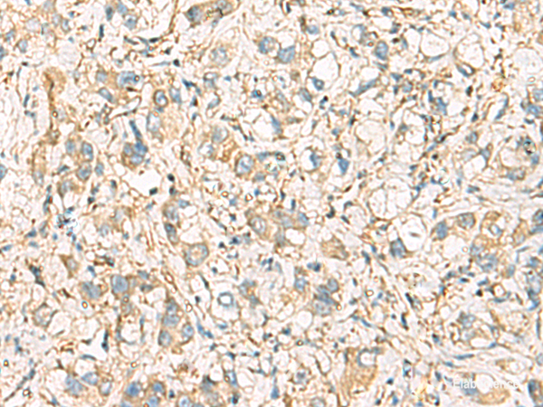 Immunohistochemistry of paraffin-embedded Human liver cancer tissue using IDS Polyclonal Antibody at dilution of 1:60(×200)