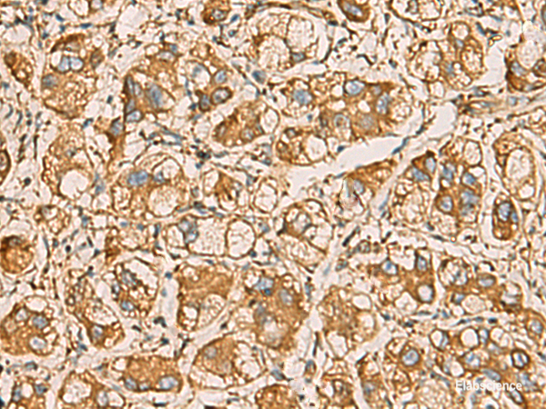Immunohistochemistry of paraffin-embedded Human liver cancer tissue using AIMP1 Polyclonal Antibody at dilution of 1:55(×200)
