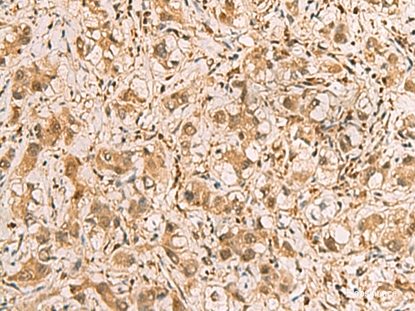 Immunohistochemistry of paraffin-embedded Human liver cancer tissue using PDXK Polyclonal Antibody at dilution of 1:75(×200)