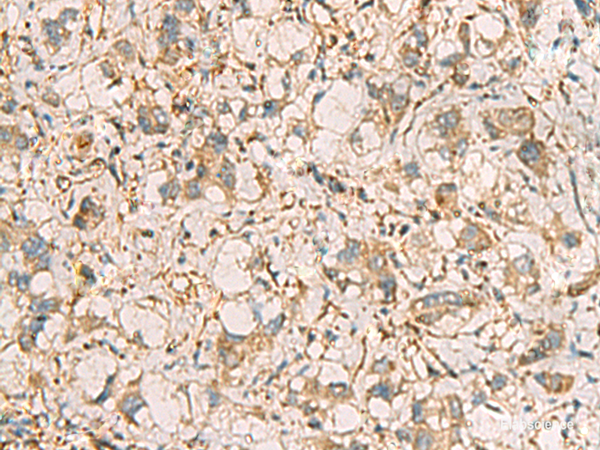 Immunohistochemistry of paraffin-embedded Human liver cancer tissue using PRKRA Polyclonal Antibody at dilution of 1:65(×200)