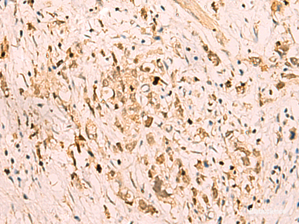 Immunohistochemistry of paraffin-embedded Human gastric cancer tissue using SGTA Polyclonal Antibody at dilution of 1:75(×200)