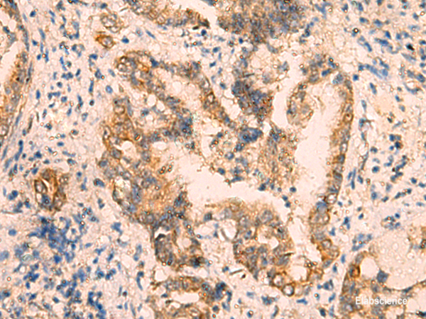 Immunohistochemistry of paraffin-embedded Human cervical cancer tissue using CRYM Polyclonal Antibody at dilution of 1:65(×200)