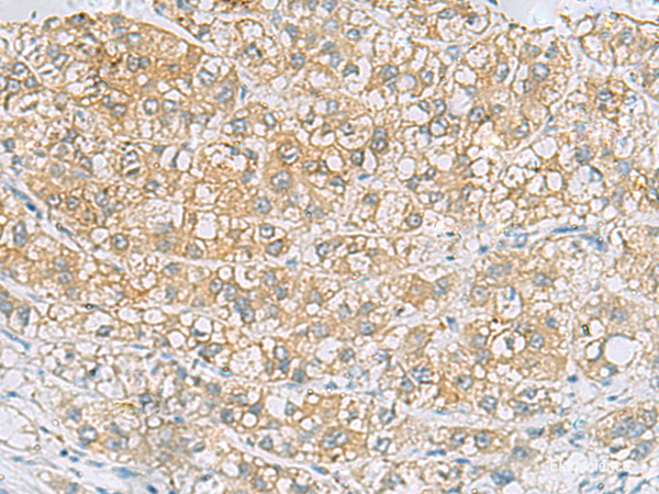 Immunohistochemistry of paraffin-embedded Human liver cancer tissue using EPCAM Polyclonal Antibody at dilution of 1:60(×200)