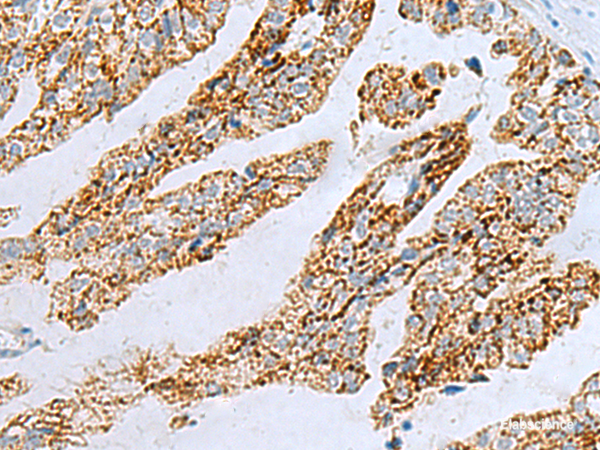 Immunohistochemistry of paraffin-embedded Human gastric cancer tissue using PYCR2 Polyclonal Antibody at dilution of 1:40(×200)