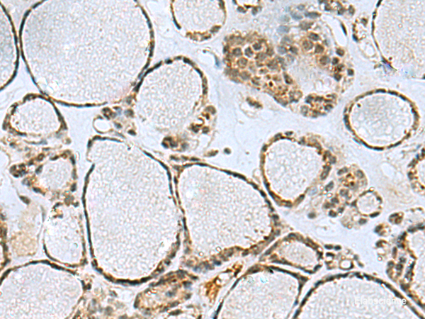 Immunohistochemistry of paraffin-embedded Human thyroid cancer tissue using PTPA Polyclonal Antibody at dilution of 1:50(×200)