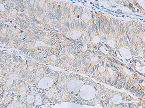Immunohistochemistry of paraffin-embedded Human colorectal cancer tissue using MSI2 Polyclonal Antibody at dilution of 1:60(×200)