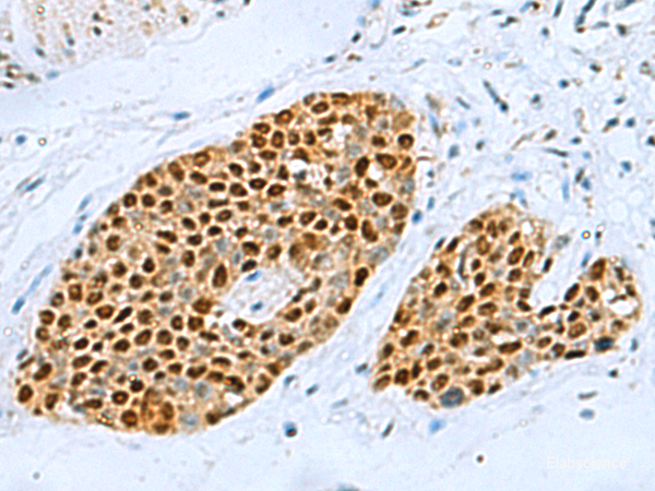 Immunohistochemistry of paraffin-embedded Human esophagus cancer tissue using TFAP4 Polyclonal Antibody at dilution of 1:70(×200)