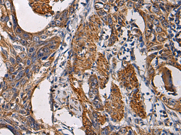 Immunohistochemistry of paraffin-embedded Human esophagus cancer tissue using SSH3 Polyclonal Antibody at dilution of 1:60(×200)