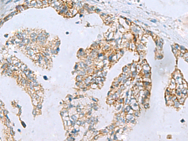 Immunohistochemistry of paraffin-embedded Human gastric cancer tissue using MGME1 Polyclonal Antibody at dilution of 1:70(×200)