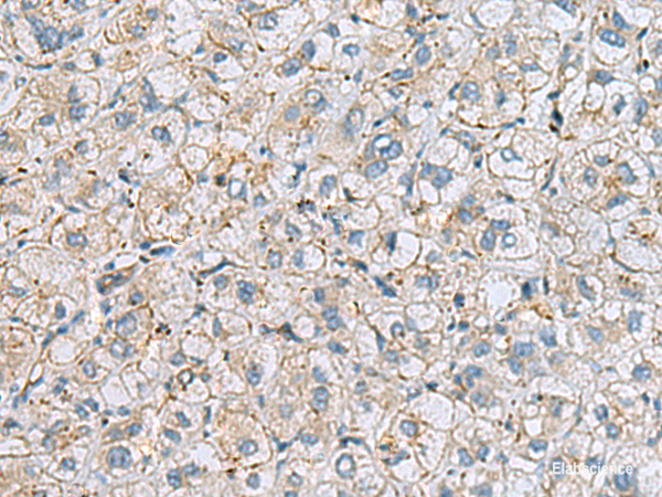 Immunohistochemistry of paraffin-embedded Human liver cancer tissue using MTHFD2 Polyclonal Antibody at dilution of 1:65(×200)