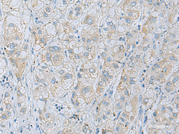 Immunohistochemistry of paraffin-embedded Human liver cancer tissue using NAGK Polyclonal Antibody at dilution of 1:35(×200)