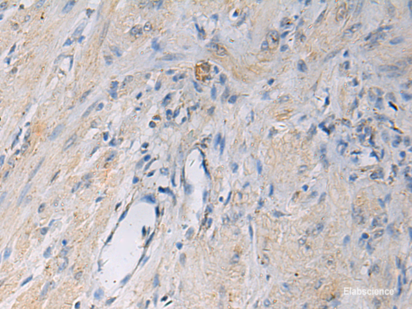 Immunohistochemistry of paraffin-embedded Human gastric cancer tissue using HSDL2 Polyclonal Antibody at dilution of 1:55(×200)