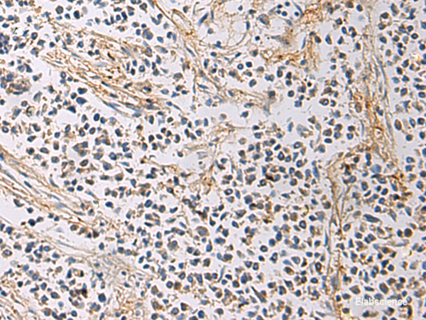 Immunohistochemistry of paraffin-embedded Human breast cancer tissue using GMPR Polyclonal Antibody at dilution of 1:60(×200)