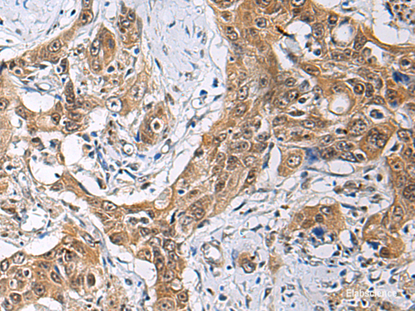 Immunohistochemistry of paraffin-embedded Human esophagus cancer tissue using THOC3 Polyclonal Antibody at dilution of 1:85(×200)