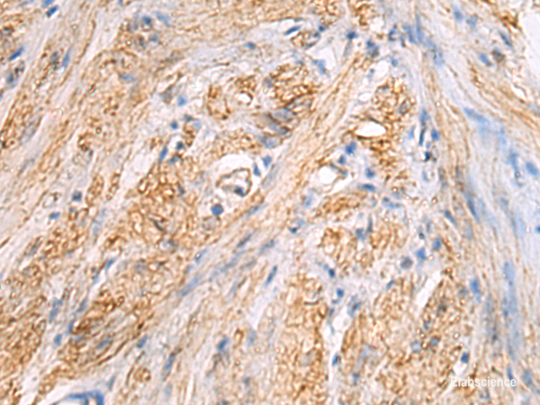 Immunohistochemistry of paraffin-embedded Human gastric cancer tissue using TMOD3 Polyclonal Antibody at dilution of 1:70(×200)