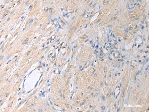 Immunohistochemistry of paraffin-embedded Human gastric cancer tissue using GNAI1 Polyclonal Antibody at dilution of 1:130(×200)