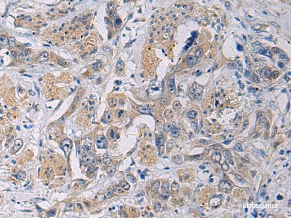 Immunohistochemistry of paraffin-embedded Human esophagus cancer tissue using CYTIP Polyclonal Antibody at dilution of 1:50(×200)