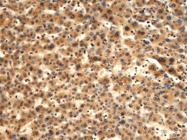 Immunohistochemistry of paraffin-embedded Human liver cancer tissue using TMOD1 Polyclonal Antibody at dilution of 1:60(×200)