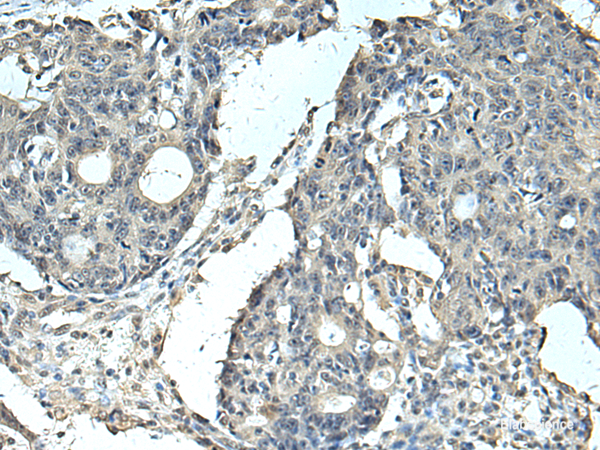 Immunohistochemistry of paraffin-embedded Human colorectal cancer tissue using SLC35F6 Polyclonal Antibody at dilution of 1:95(×200)