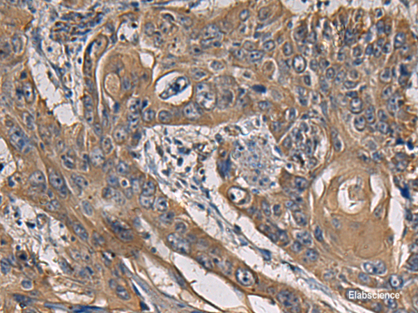 Immunohistochemistry of paraffin-embedded Human esophagus cancer tissue using CCNI Polyclonal Antibody at dilution of 1:65(×200)