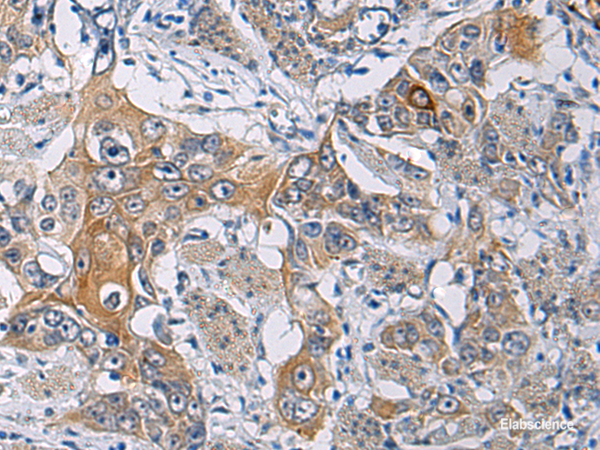 Immunohistochemistry of paraffin-embedded Human esophagus cancer tissue using KCNJ10 Polyclonal Antibody at dilution of 1:60(×200)