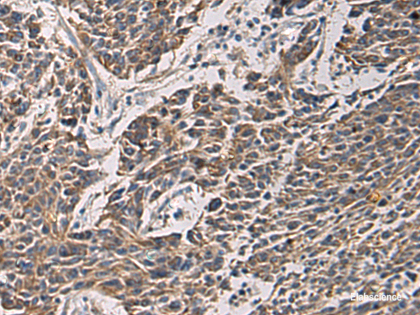 Immunohistochemistry of paraffin-embedded Human colorectal cancer tissue using MAPKAPK3 Polyclonal Antibody at dilution of 1:95(×200)