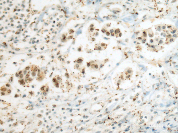 Immunohistochemistry of paraffin-embedded Human breast cancer tissue using SEPHS1 Polyclonal Antibody at dilution of 1:80(×200)