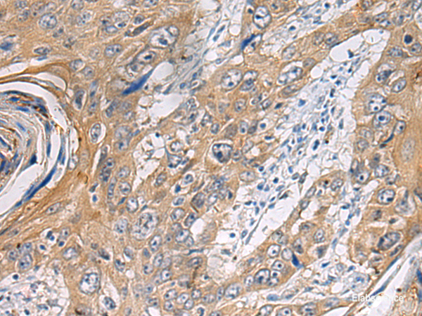 Immunohistochemistry of paraffin-embedded Human esophagus cancer tissue using PA2G4 Polyclonal Antibody at dilution of 1:60(×200)