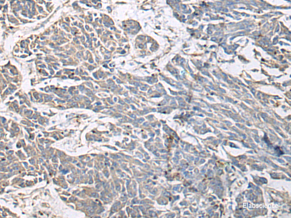 Immunohistochemistry of paraffin-embedded Human colorectal cancer tissue using PRKCSH Polyclonal Antibody at dilution of 1:65(×200)