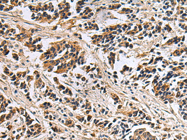 Immunohistochemistry of paraffin-embedded Human breast cancer tissue using DIAPH2 Polyclonal Antibody at dilution of 1:55(×200)