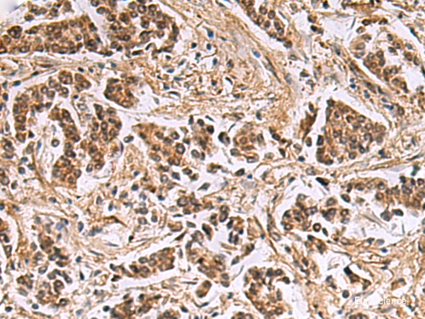 Immunohistochemistry of paraffin-embedded Human breast cancer tissue using DNA2 Polyclonal Antibody at dilution of 1:40(×200)