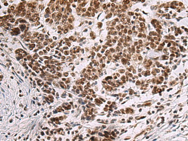 Immunohistochemistry of paraffin-embedded Human colorectal cancer tissue using CREBBP Polyclonal Antibody at dilution of 1:60(×200)