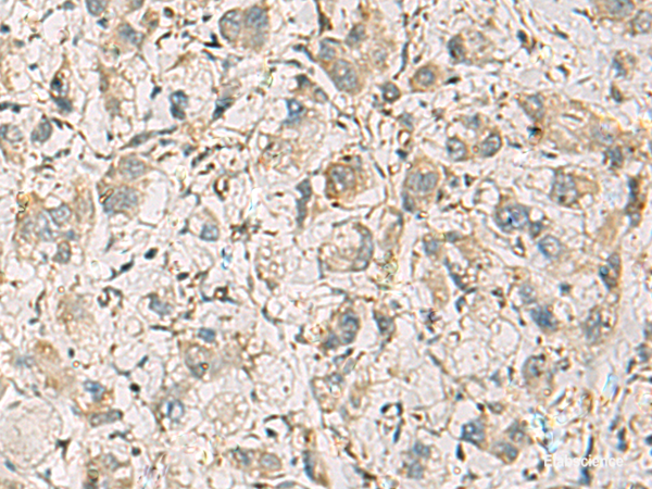 Immunohistochemistry of paraffin-embedded Human liver cancer tissue using CMTM1 Polyclonal Antibody at dilution of 1:40(×200)