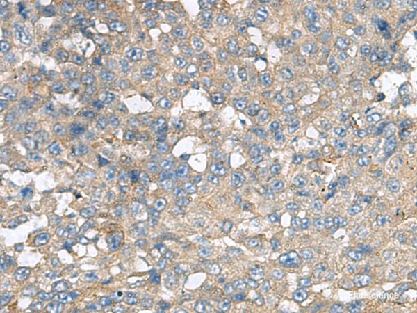 Immunohistochemistry of paraffin-embedded Human liver cancer tissue using CXCR5 Polyclonal Antibody at dilution of 1:80(×200)