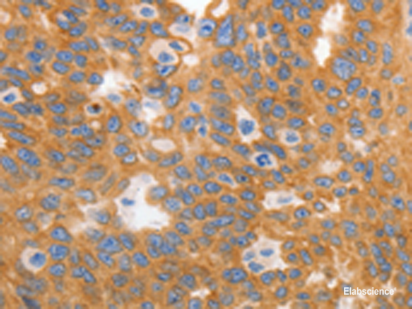 Immunohistochemistry of paraffin-embedded Human ovarian cancer tissue using MYOD1 Polyclonal Antibody at dilution of 1:120(×200)