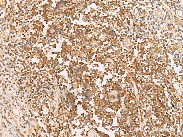 Immunohistochemistry of paraffin-embedded Human prost at e cancer tissue using PAX5 Polyclonal Antibody at dilution of 1:30(×200)