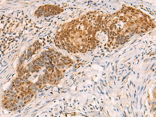 Immunohistochemistry of paraffin-embedded Human esophagus cancer tissue using SREBF2 Polyclonal Antibody at dilution of 1:50(×200)
