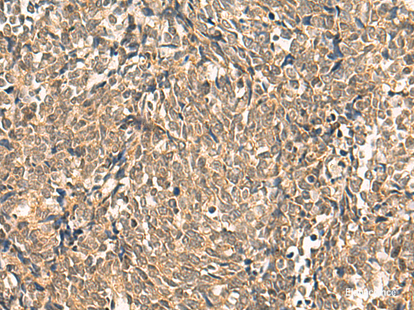 Immunohistochemistry of paraffin-embedded Human lung cancer tissue using HNF1A Polyclonal Antibody at dilution of 1:50(×200)