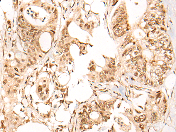 Immunohistochemistry of paraffin-embedded Human colorectal cancer tissue using ARID1B Polyclonal Antibody at dilution of 1:40(×200)