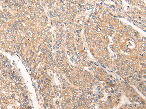 Immunohistochemistry of paraffin-embedded Human liver cancer tissue using PIAS3 Polyclonal Antibody at dilution of 1:40(×200)