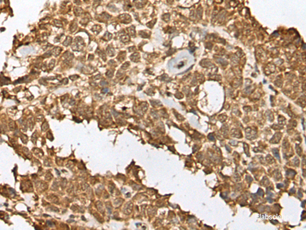 Immunohistochemistry of paraffin-embedded Human ovarian cancer tissue using RBL2 Polyclonal Antibody at dilution of 1:45(×200)