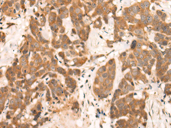 Immunohistochemistry of paraffin-embedded Human thyroid cancer tissue using NRG2 Polyclonal Antibody at dilution of 1:65(×200)
