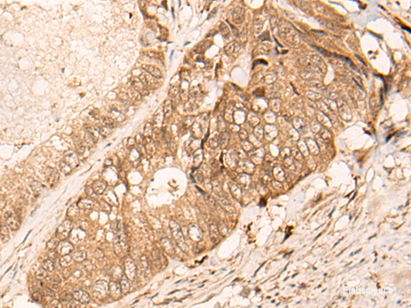 Immunohistochemistry of paraffin-embedded Human colorectal cancer tissue using HIPK3 Polyclonal Antibody at dilution of 1:60(×200)