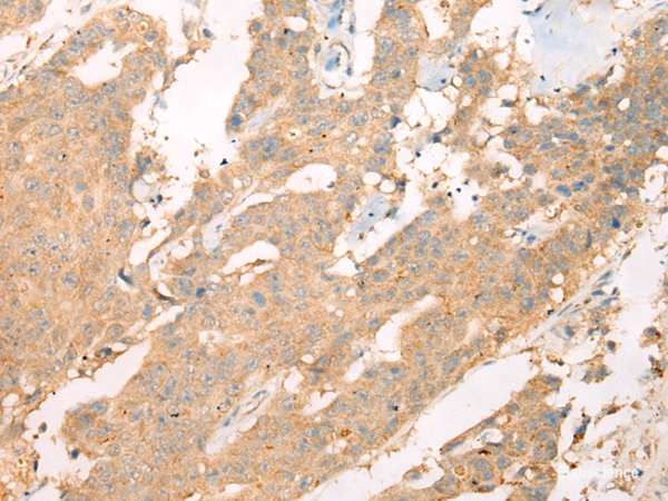 Immunohistochemistry of paraffin-embedded Human colorectal cancer tissue using ASIC3 Polyclonal Antibody at dilution of 1:40(×200)