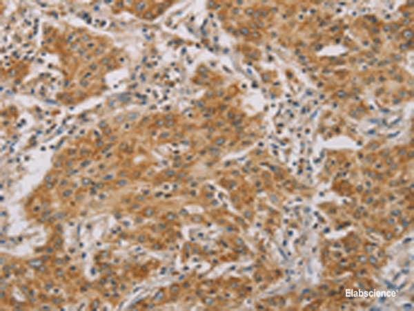 Immunohistochemistry of paraffin-embedded Human gasrtic cancer tissue using CDKN2A Polyclonal Antibody at dilution of 1:50(×200)