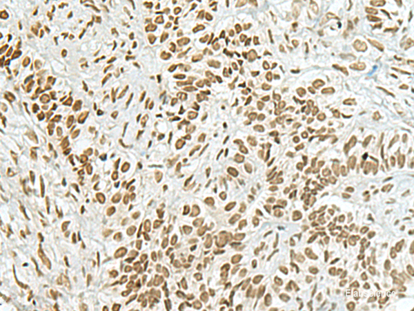 Immunohistochemistry of paraffin-embedded Human ovarian cancer tissue using HAS1 Polyclonal Antibody at dilution of 1:70(×200)