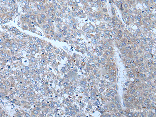 Immunohistochemistry of paraffin-embedded Human liver cancer tissue using SLC24A5 Polyclonal Antibody at dilution of 1:50(×200)